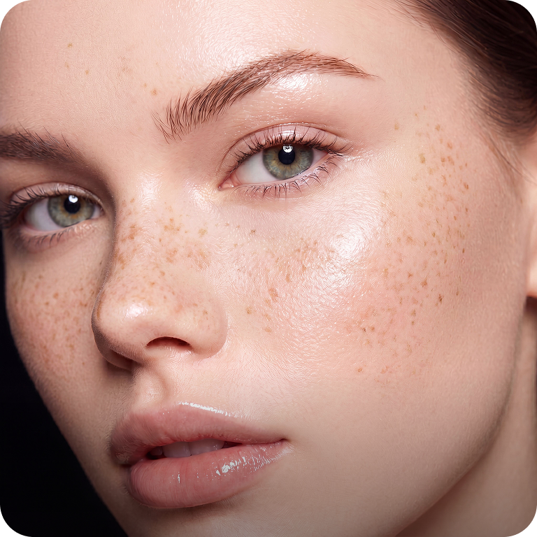 Freckles